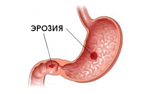Острый эрозивный гастрит как лечить