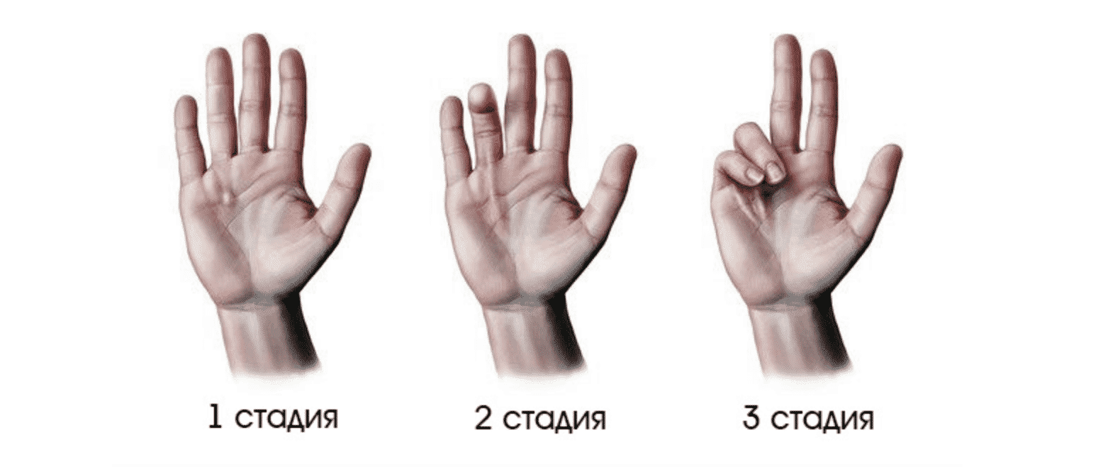 Контрактура Дюпюитрена (Ладонный фиброматоз) — симптомы, лечение